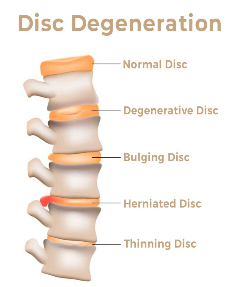 Back Pain - Back to the Basics - Neo Chiropractic